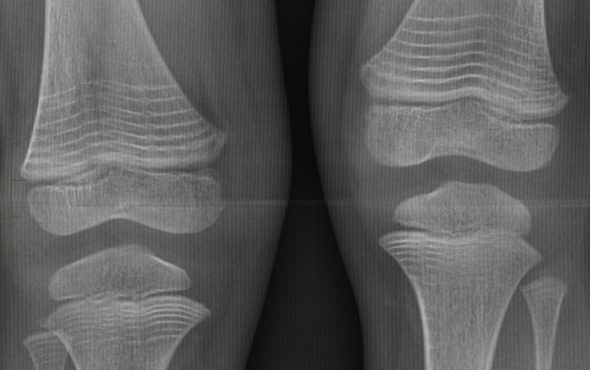 Figure 2 for case OSTEOGENESIS IMPERFECTA